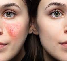 Prix pour une greffe de cheveux à Marseille 13007