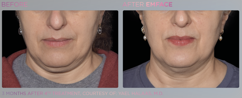 EM Face - Submentum pour traiter le double menton à Marseille