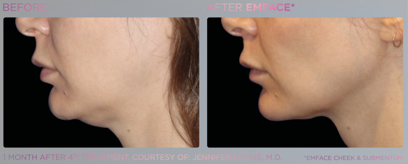 EM Face - Submentum pour traiter le double menton à Marseille