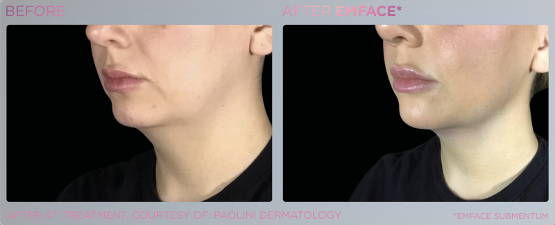 EM Face - Submentum pour traiter le double menton à Marseille