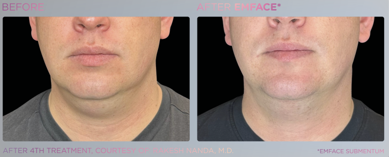 EM Face - Submentum pour traiter le double menton à Marseille