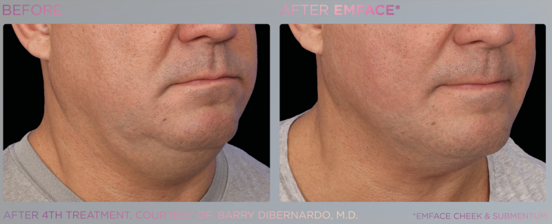 EM Face - Submentum pour traiter le double menton à Marseille