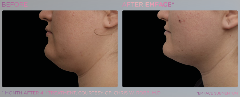 EM Face - Submentum pour traiter le double menton à Marseille