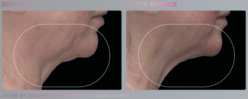 EM Face - Submentum pour traiter le double menton à Marseille