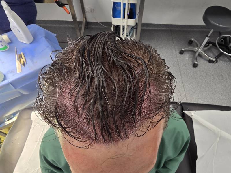 FUE Long Hair à Marseille - La révolution de la Greffe sans rasage