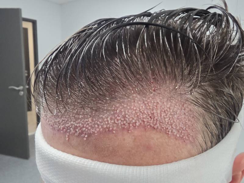 Greffe FUE Unshaved à Marseille – La greffe de cheveux sans rasage chez Cap'Clinic