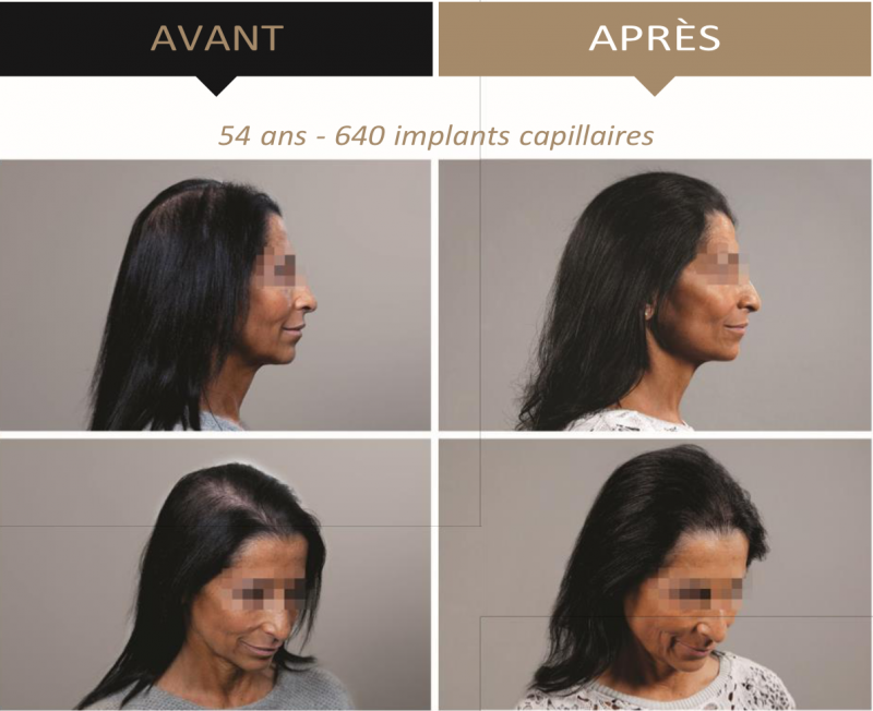 Greffe de cheveux synthétiques à Marseille