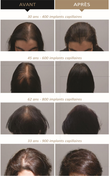 Greffe de cheveux synthétiques à Marseille