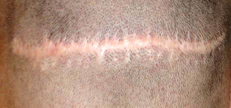 Recouvrir cicatrice bandelette (FUT) par greffe capillaire FUE Marseille