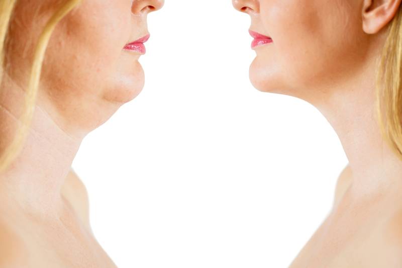 Injection Agents lipolytiques et défibrosants Marseille