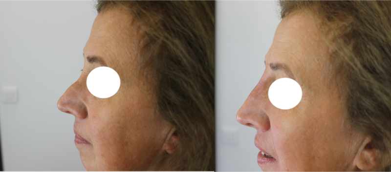 Rhinoplastie médicale à Marseille