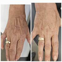 Notre zone d'activité pour ce service Traitement des rides statiques et profondes par du botox à