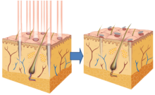 Notre zone d'activité pour ce service Traitement FUE pour lutter contre la calvitie à